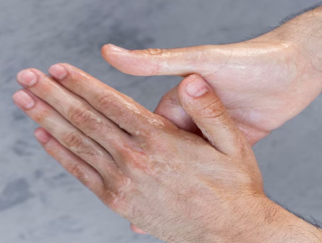 علائم پیری پوست دست